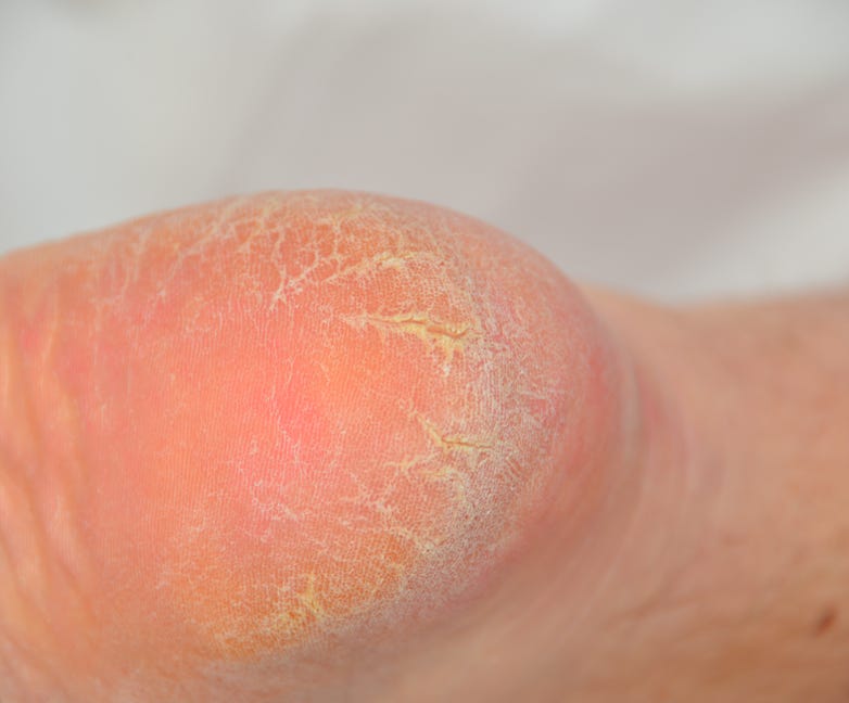 Patient being treated for cracked hells by Feet For Purpose