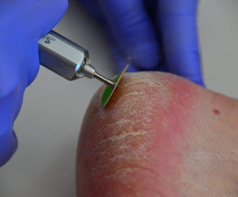Patient with hard skin on their heels being treated by Feet For Purpose